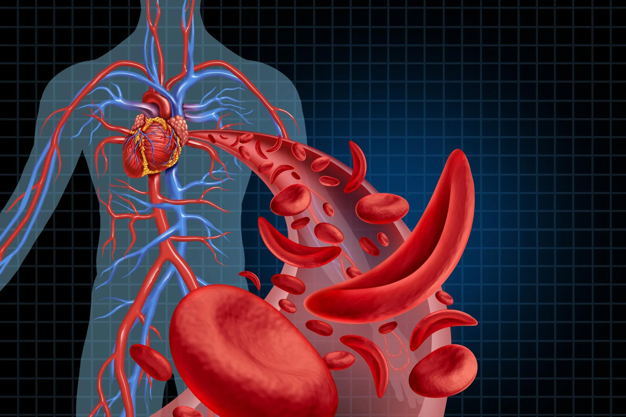 Abdominal Aortic Aneurysm