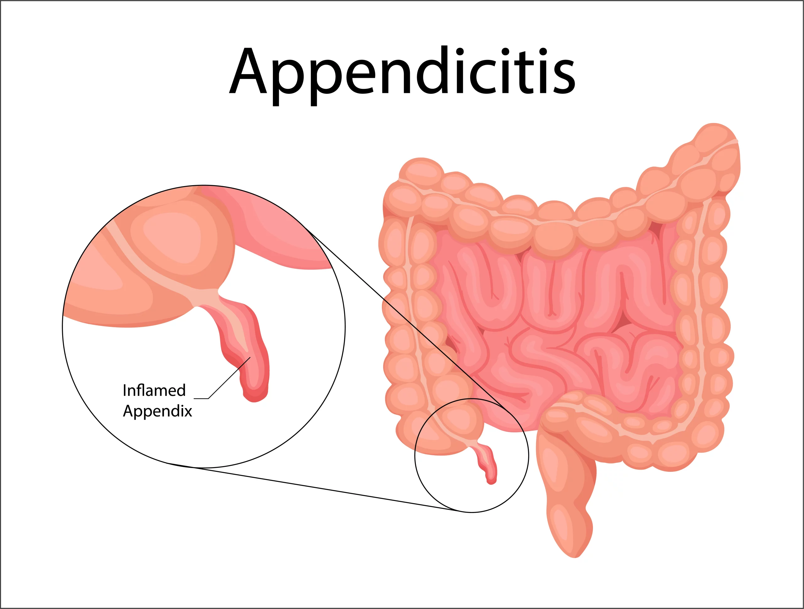 Appendicitis