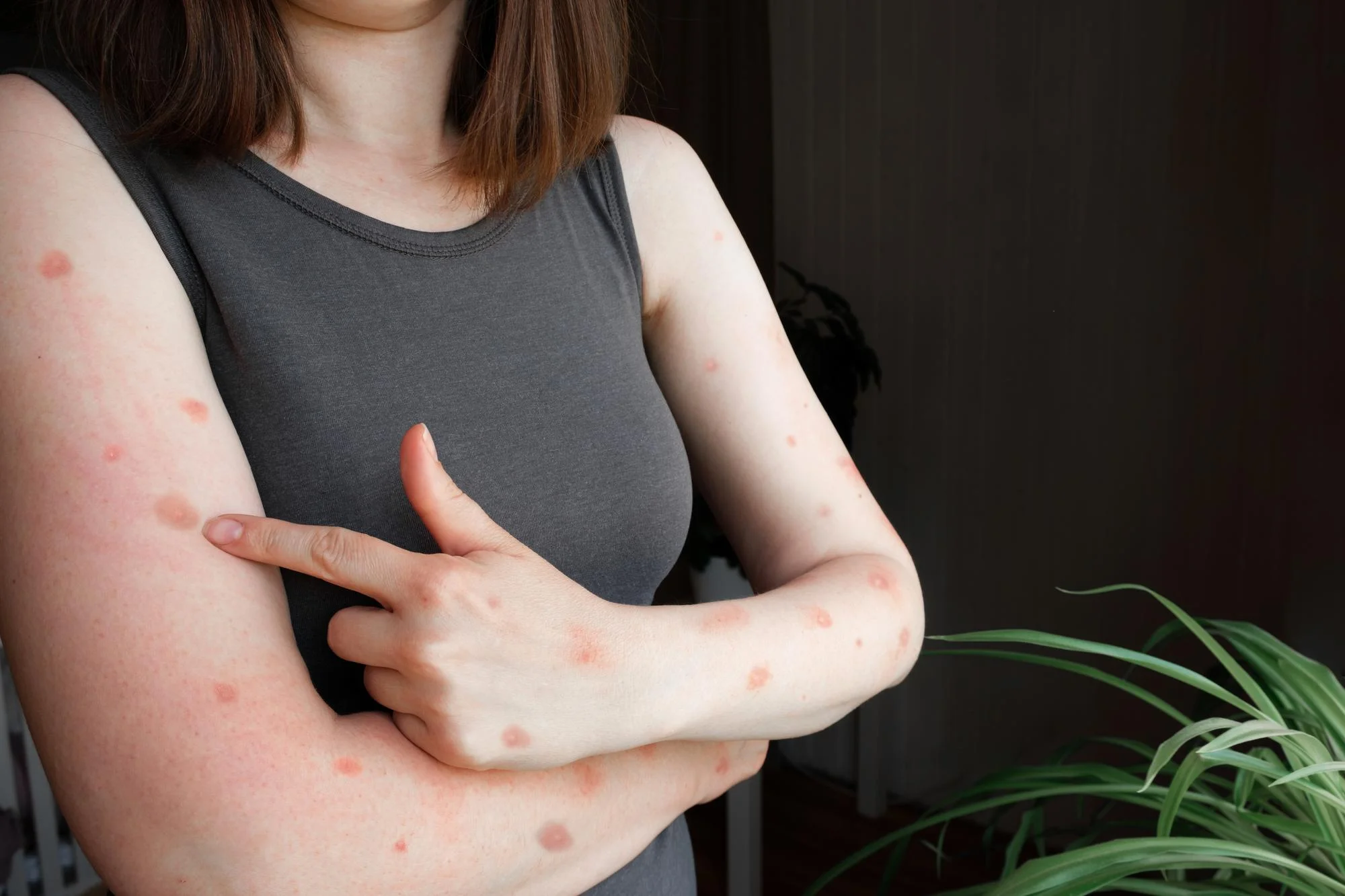 Discoid eczema