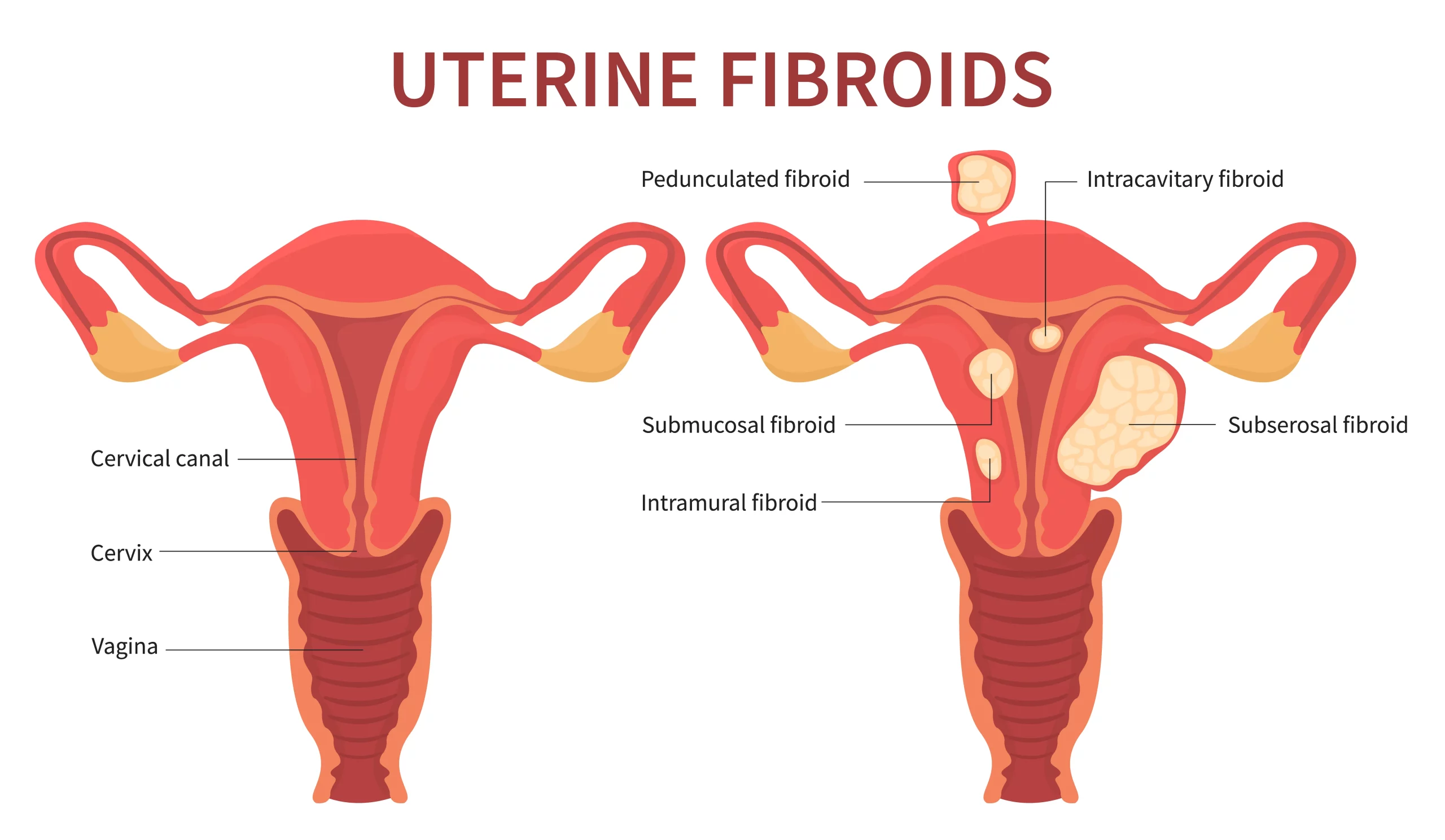 Fibroids