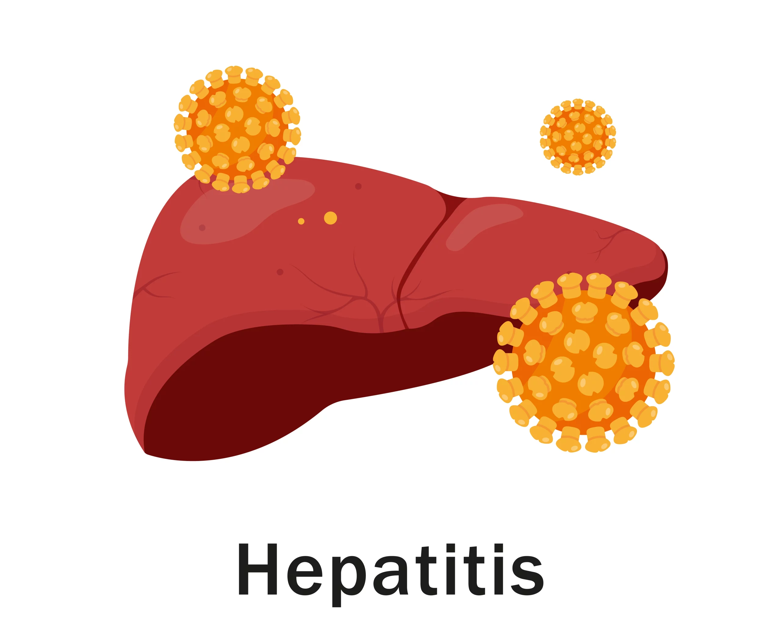 Hepatitis A