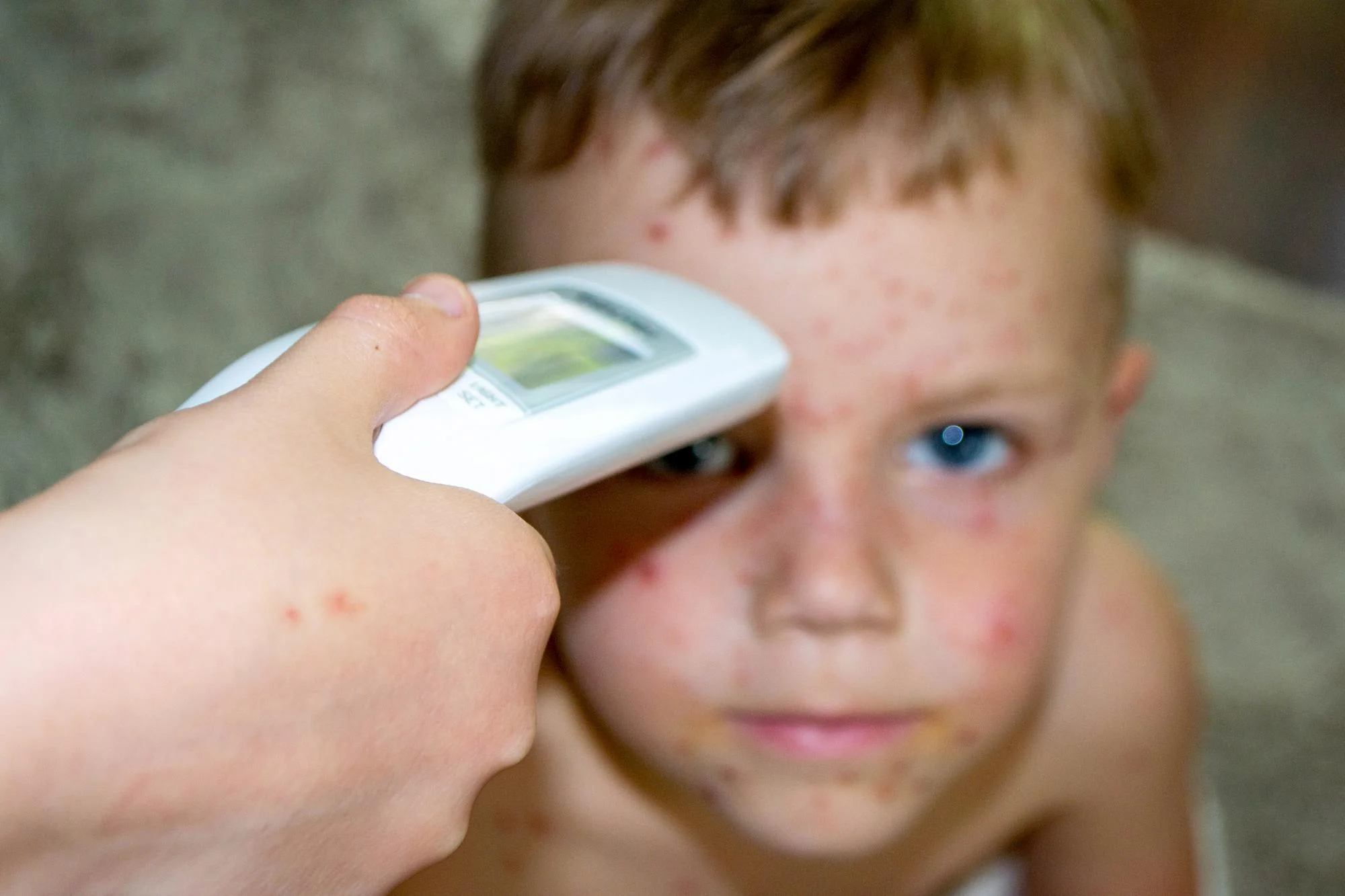 Measles