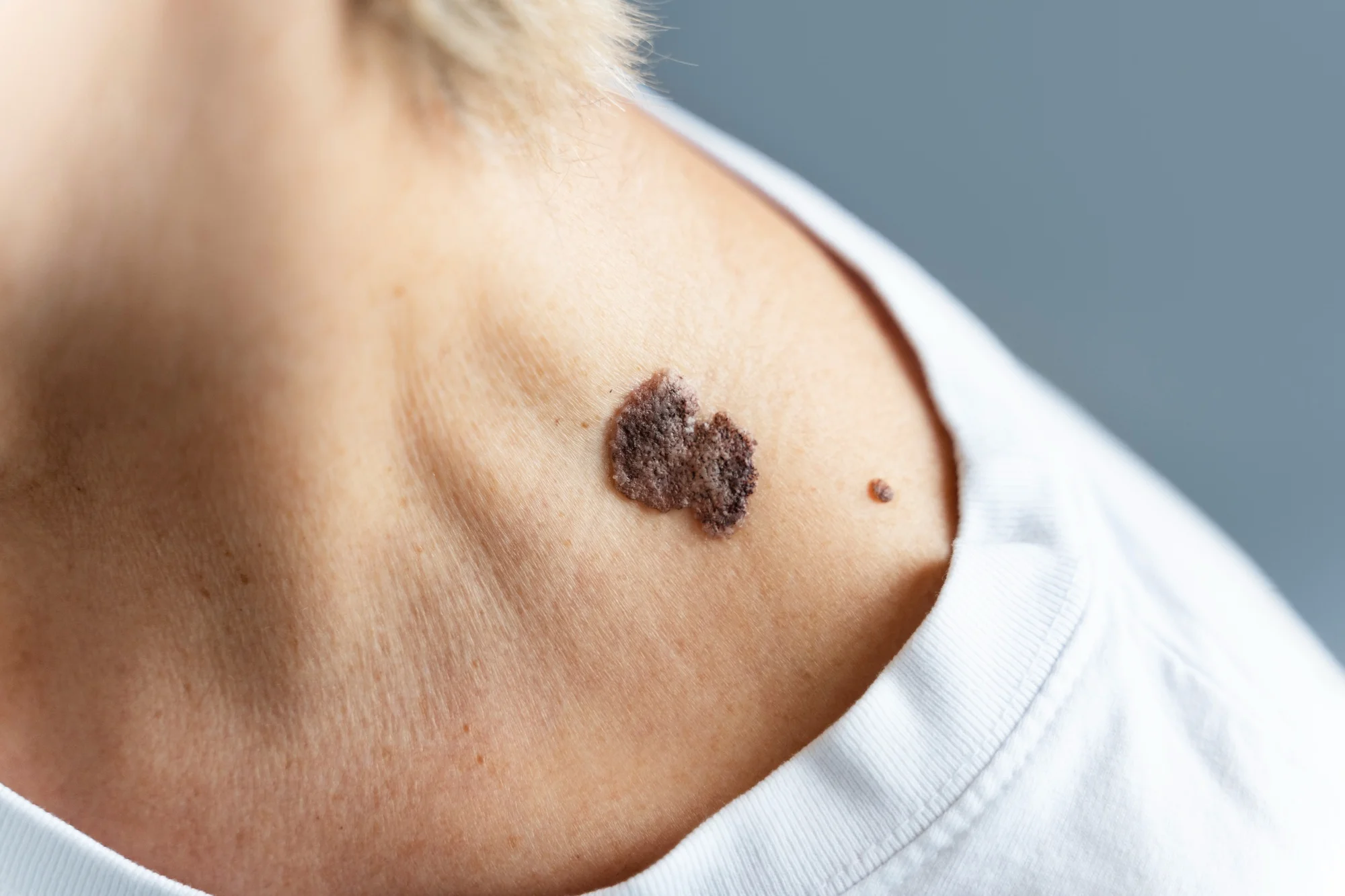 Melanoma