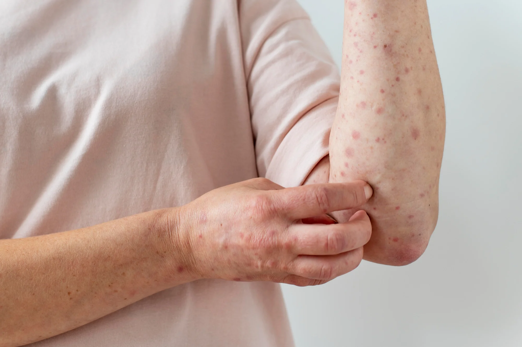 Scabies