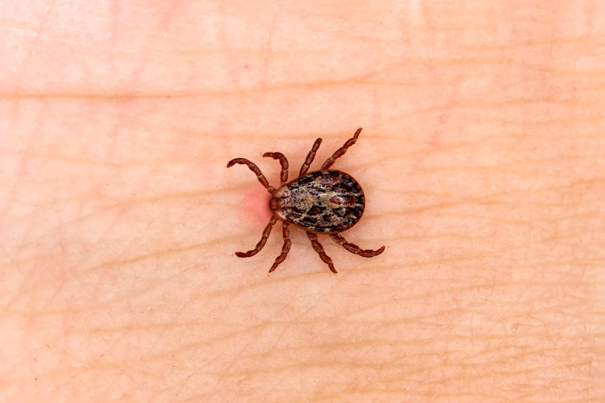 lyme disease