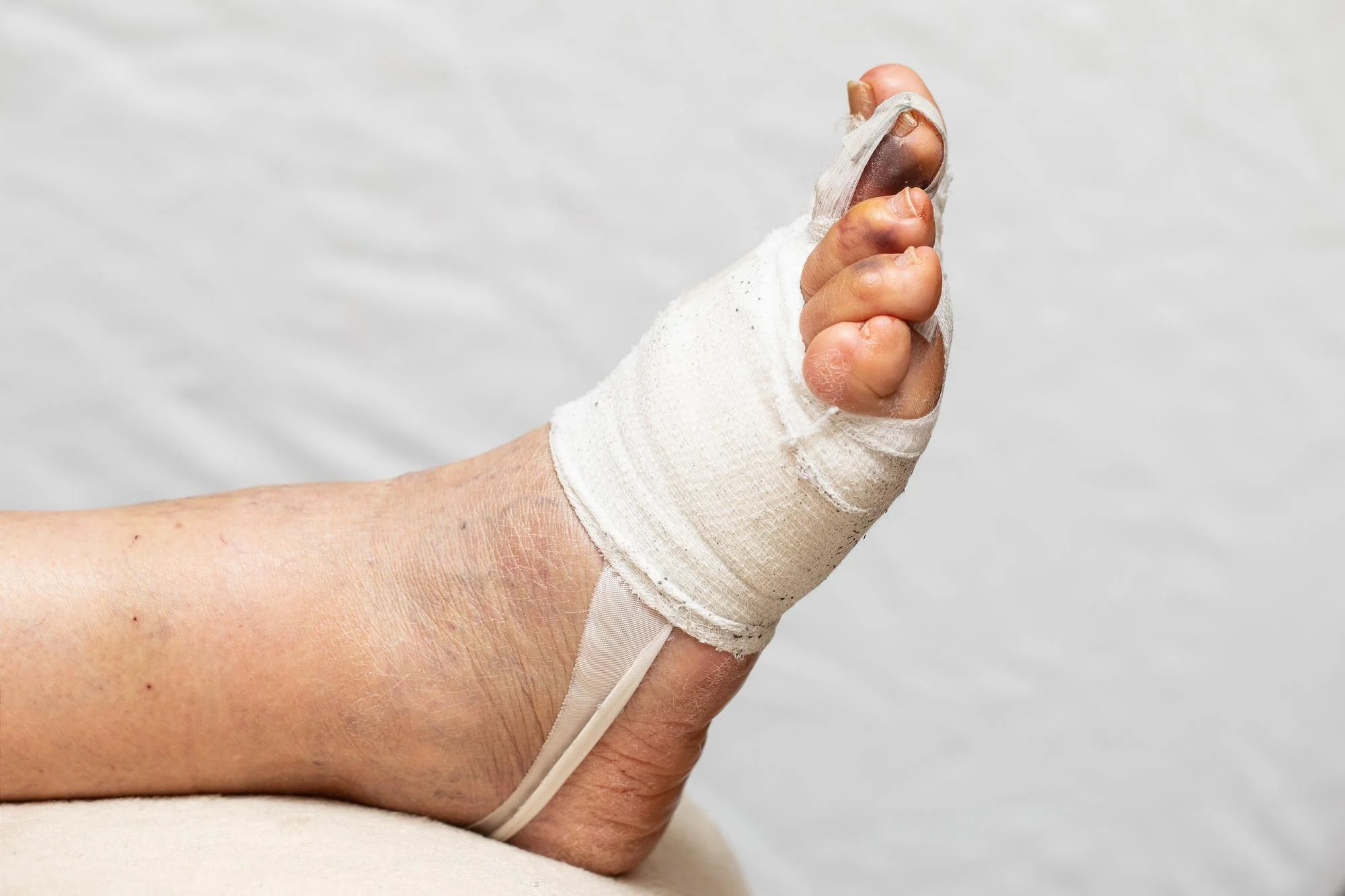 Bunion surgery