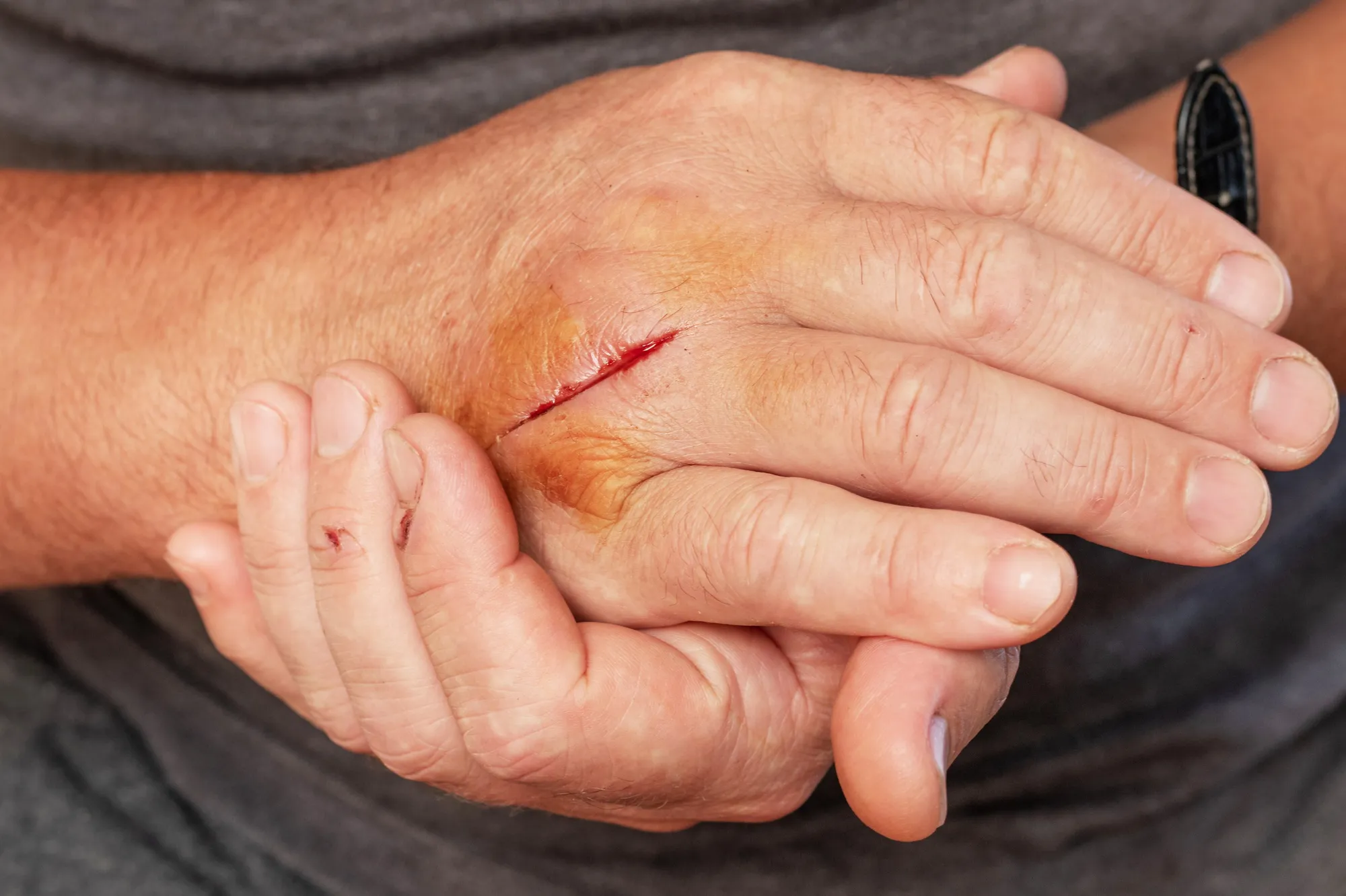 Diabetic wound
