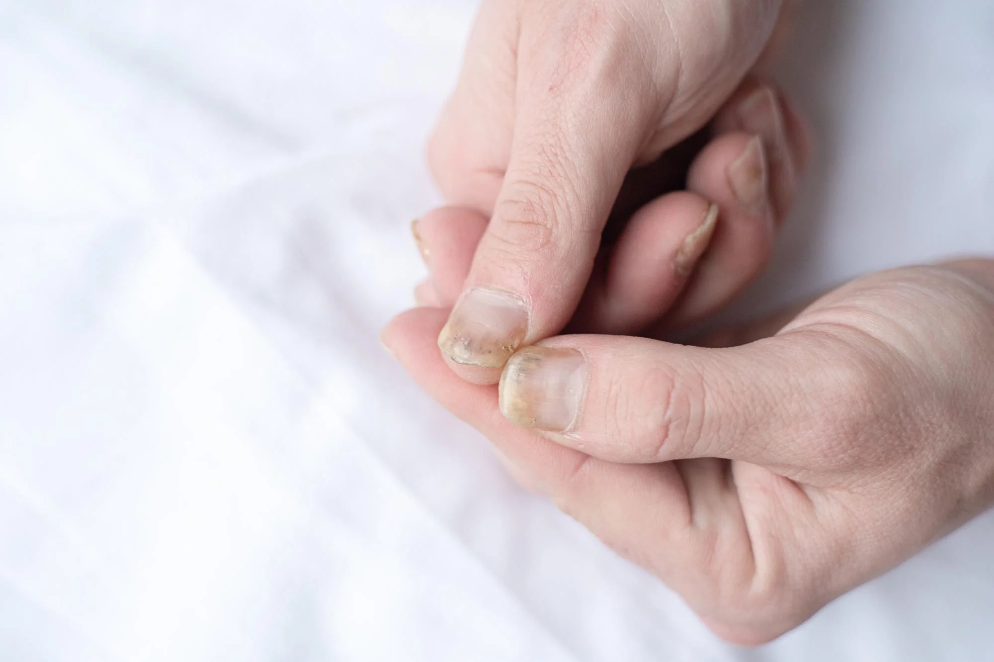 Nail fungal infection