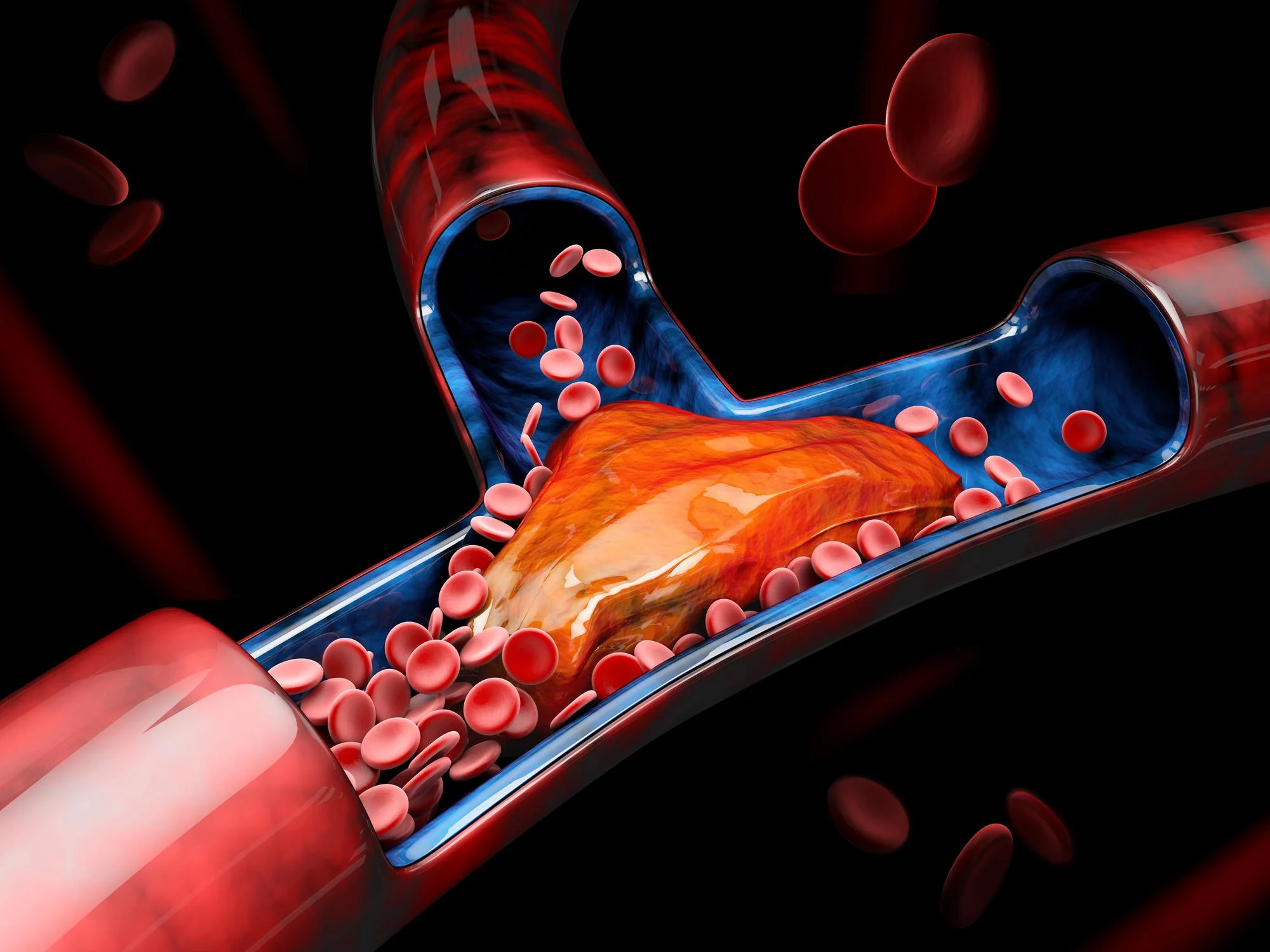 Thrombosis