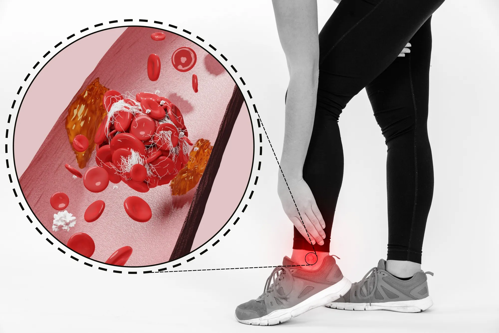 Thromboembolic Disease