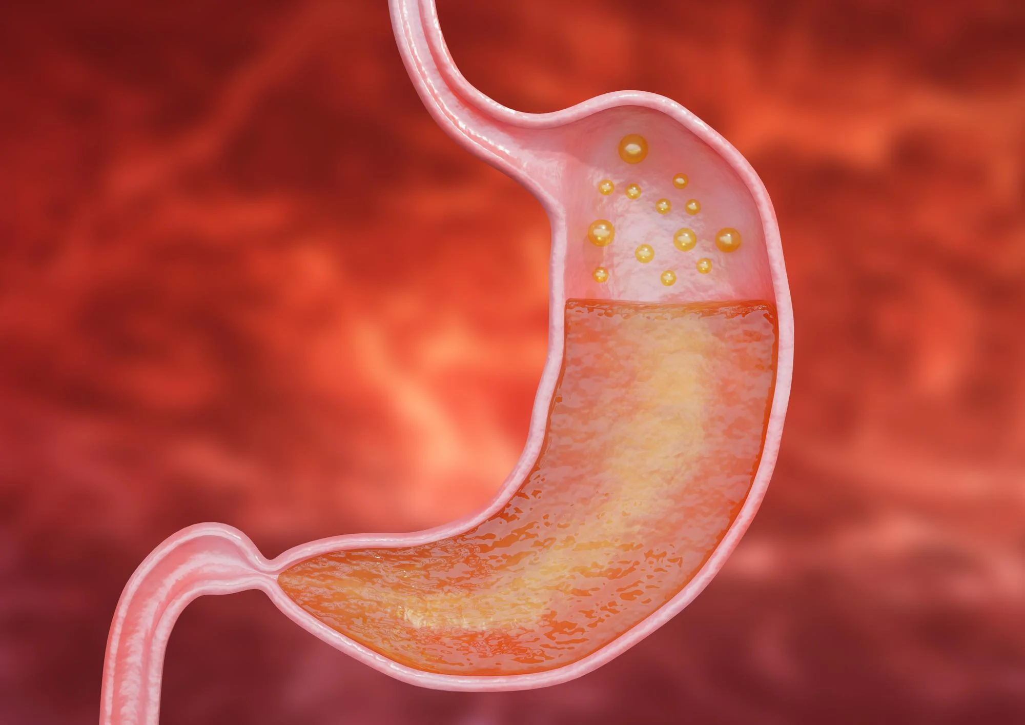 Gastric Cancer