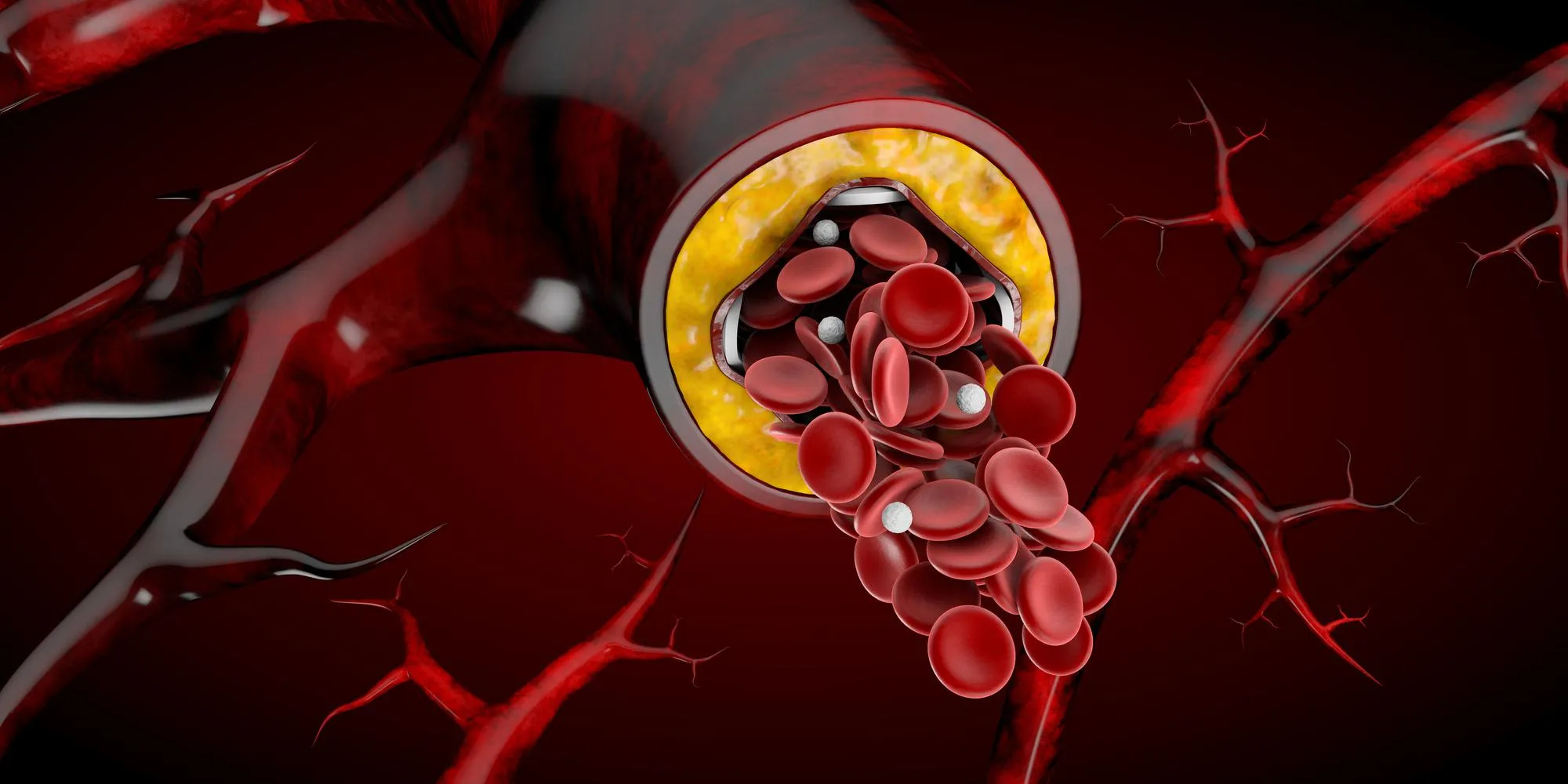 Glomerular disease
