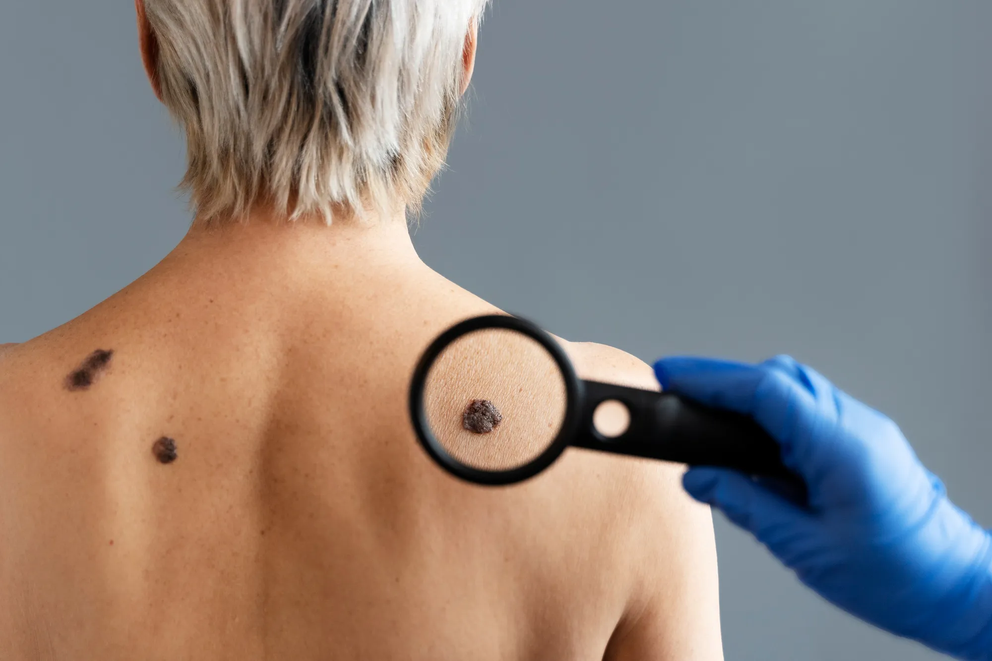 Melanoma treatment