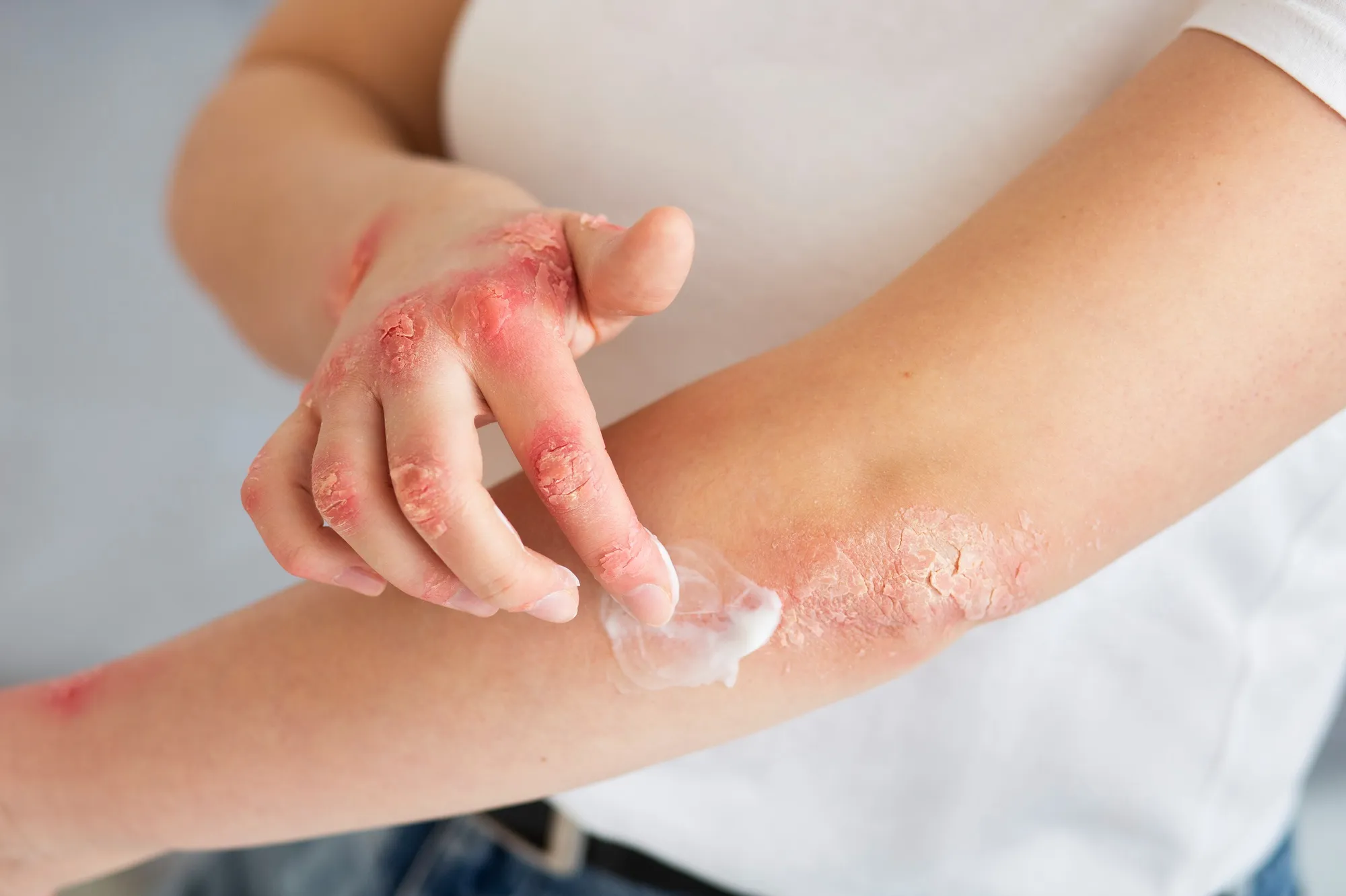 Pediatric psoriasis