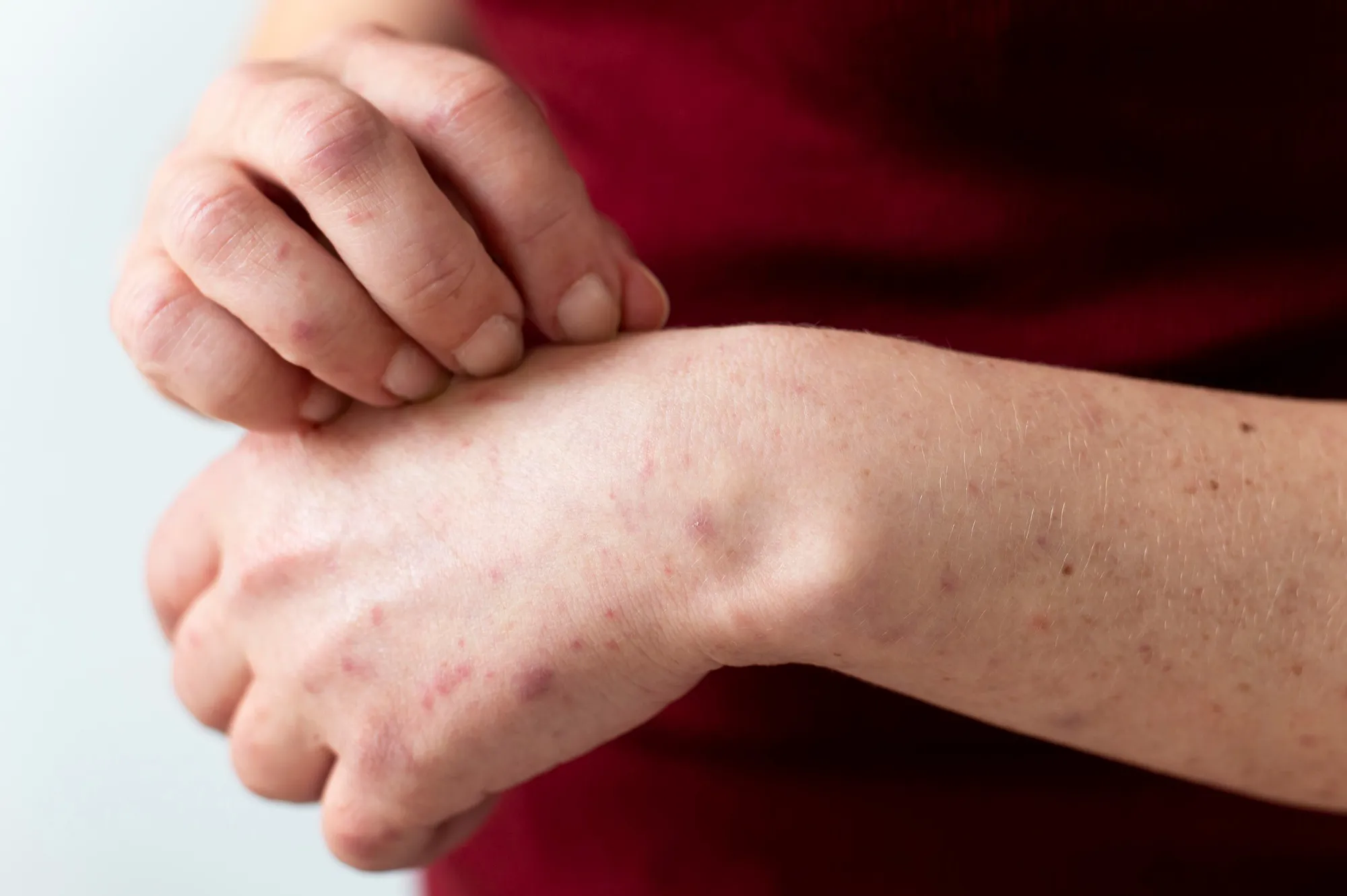 West Nile virus