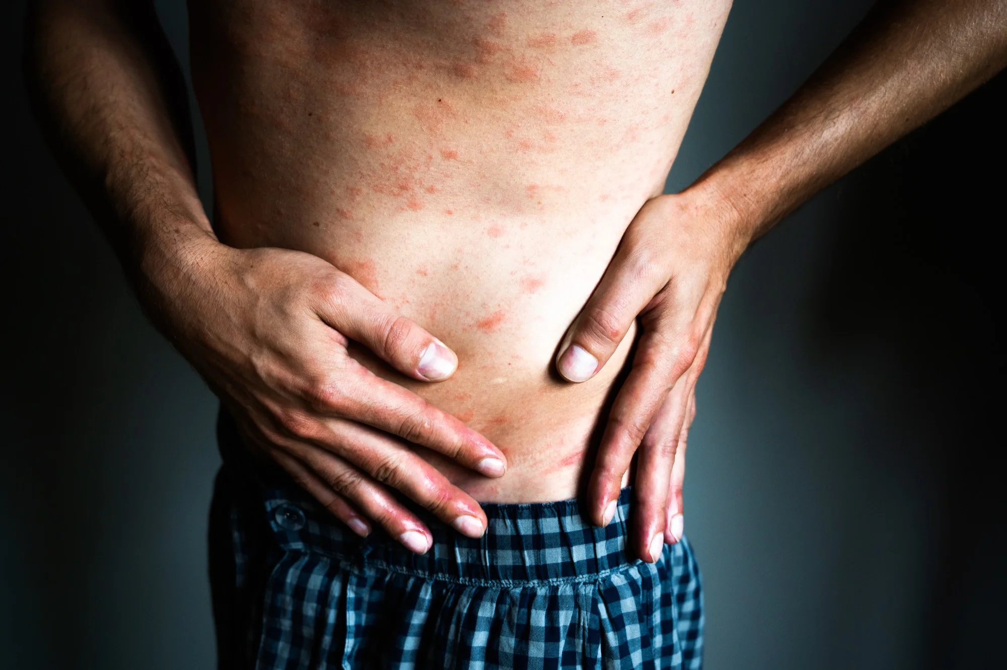Peri stromal skin irritation